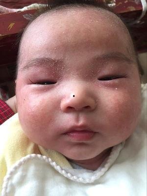 湿疹吃云南小瓜好吗,云南小瓜助力缓解不适